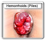Hemorrhoids or Piles