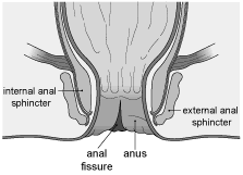  anal fissure