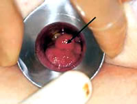 shreyas anorectal hospital - polyps rectum, polyp rectum, rectal polyps, rectal polyp, rectum polyps